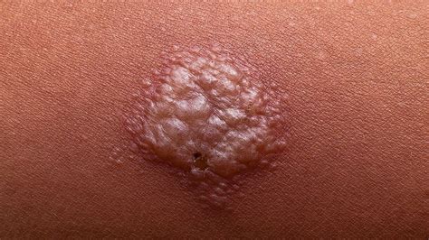 what does a positive tb test look like|Tuberculosis skin test: What to expect, diagnosis, .